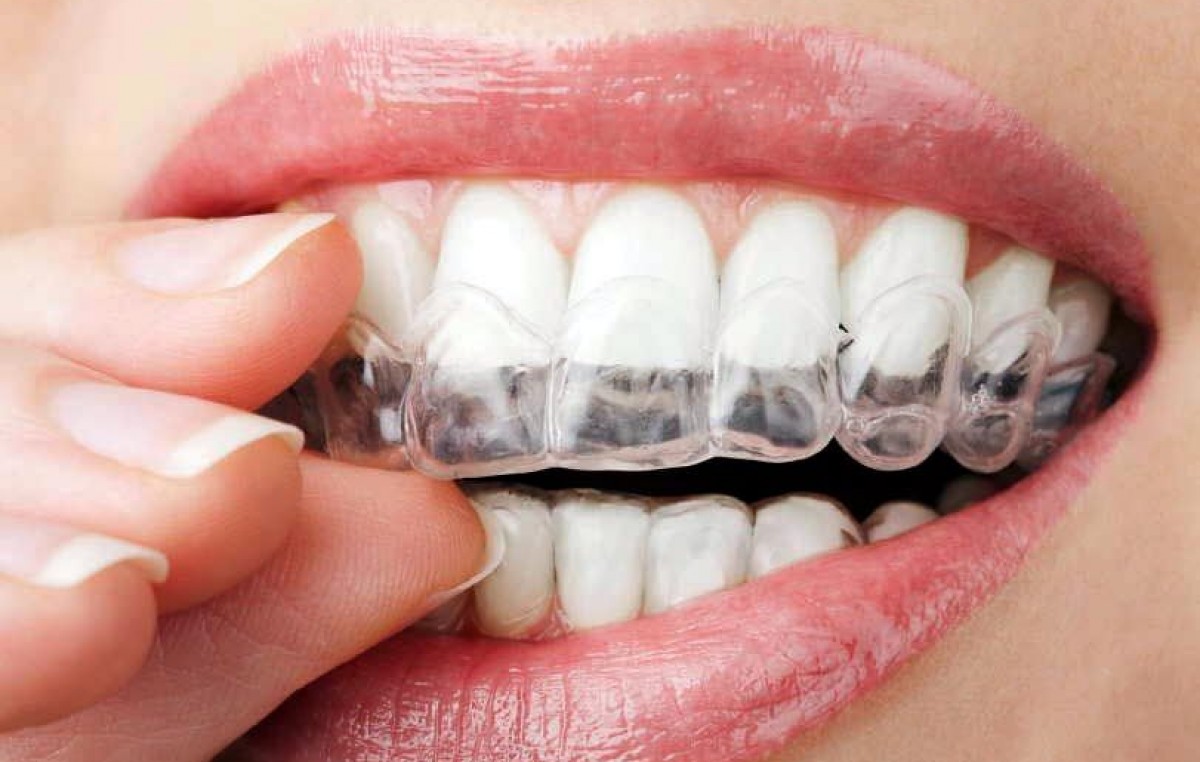 Argentinos desarrollaron ortodoncia con tecnología 3D